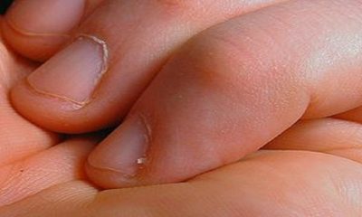 طبيب يحذر من خطر سأف الأظافر