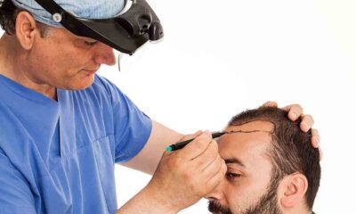 زراعة الشعر في السعودية 2023