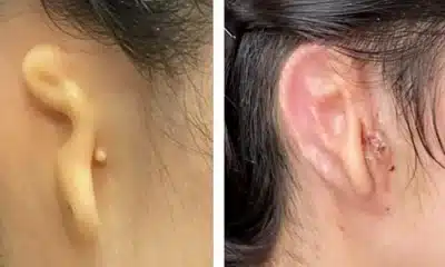 الأولى من نوعها.. زرع أذن مطبوعة لكنها "حقيقية"