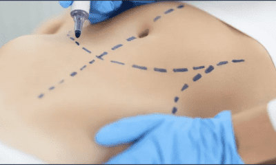 نزفت 8 ساعات.. شفط دهون بمركز تجميل يهز الأردن
