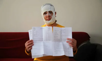 جلسة تجميل تنتهي بكارثة.. حروق من الدرجة الثانية لامرأة تركية! (فيديو)