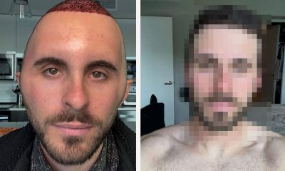 قبل وبعد زراعة الشعر.. صور سائح أجنبي في تركيا تخطف الأنظار