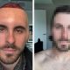 قبل وبعد زراعة الشعر.. صور سائح أجنبي في تركيا تخطف الأنظار